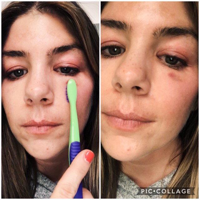 Beauty blogger explains botox bruising.