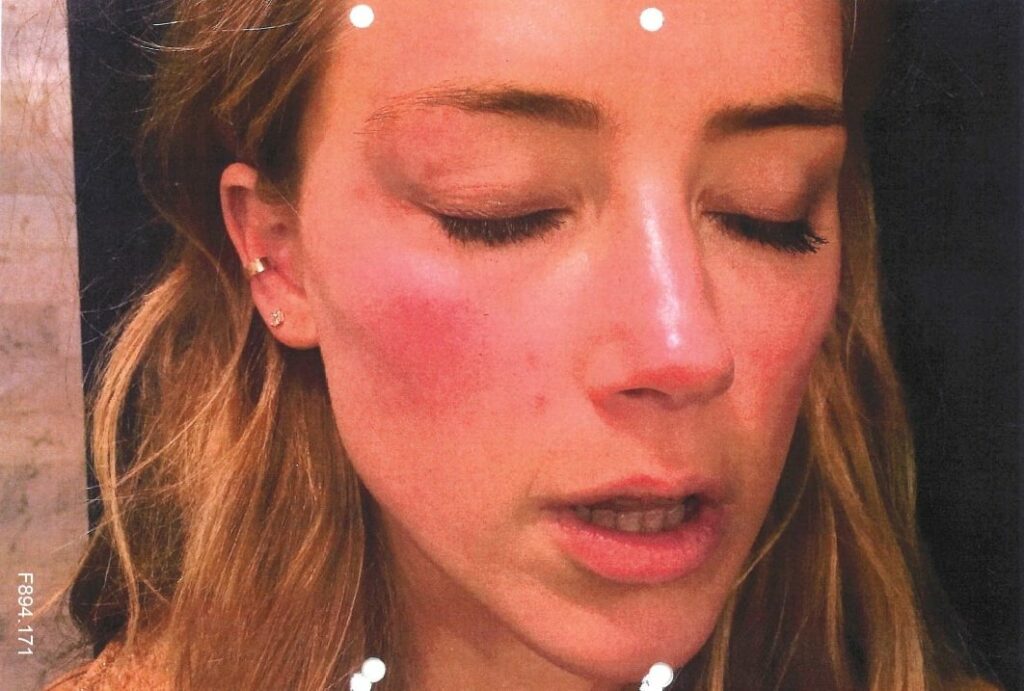 Amber Heard red face from drinking